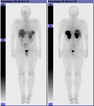 Somatostatin receptor scintigraphy