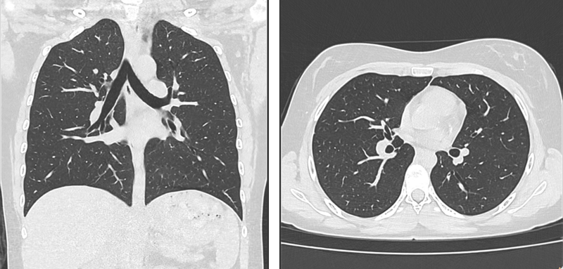 Thorax Lung Screening