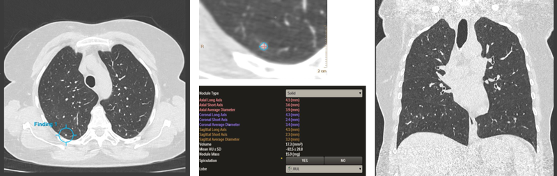 Thorax Lung Screening