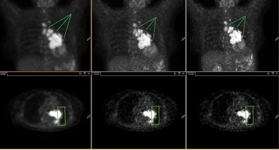 PET/CT Bilder mit xSharp und xFine rekonstruiert f&uuml;r hohen Kontrast​