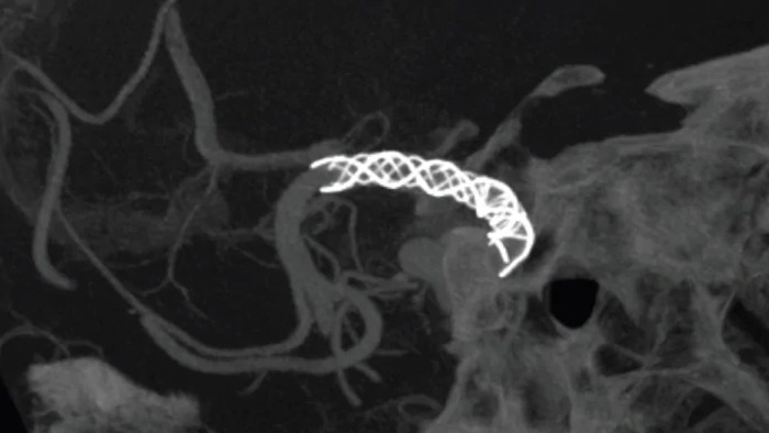 SmartCT Vaso&nbsp;IA