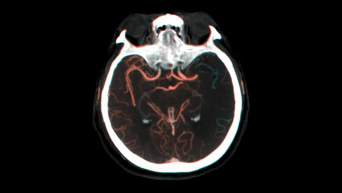Darstellung der kollateralen F&uuml;llung