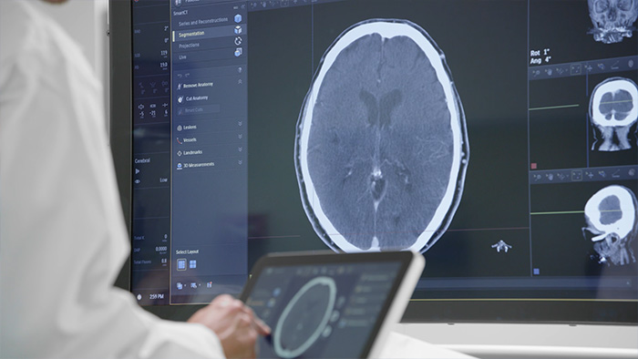 Behandlung von ischämischen Schlaganfällen