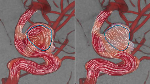 Philips AneurysmFlow
