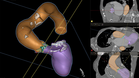 Philips Suite f&uuml;r strukturelle Herzkrankheiten