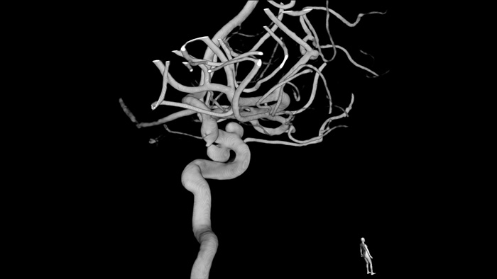 3D-RA gewundener Pathologien