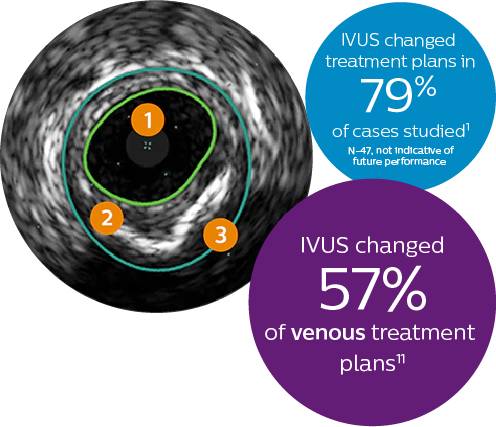 IVUS ver&auml;nderte die Behandlung