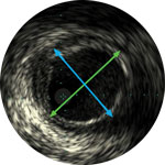 Gef&auml;&szlig;durchmesser