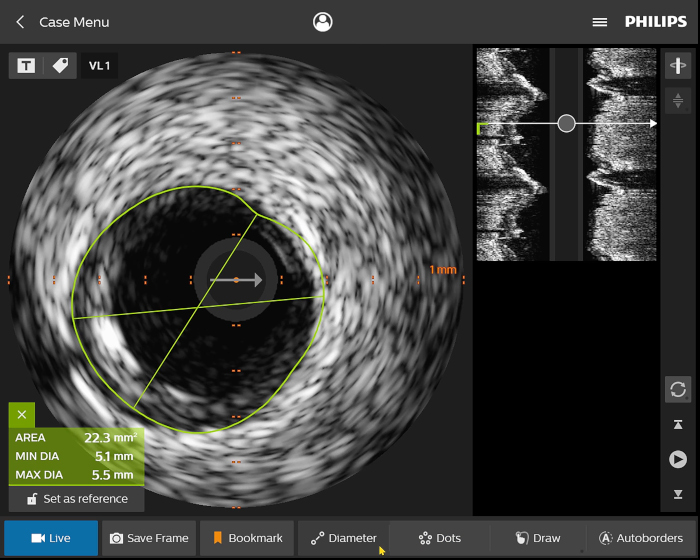 Standbild IntraSight IVUS-Fallmen&uuml;
