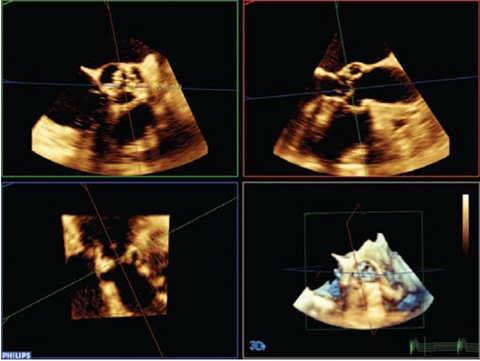 Einsatz anatomischer Intelligenz f&uuml;r Ultraschalluntersuchungen in der interventionellen Kardiologie​